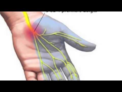 comment soigner tunnel carpien