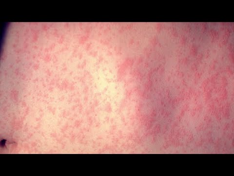 NY Long Island Nassau County Officials Publicly Warning Of New Measles Outbreak