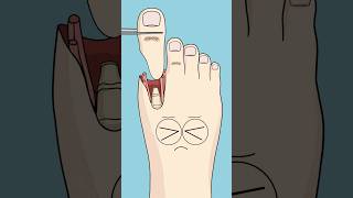 They Turned His Toe Into A Thumb