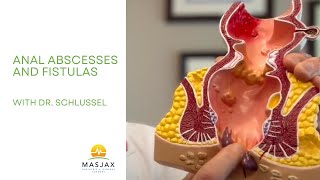 🔴 Painful Anal Abscess or Fistula Here’s What You Need to Know
