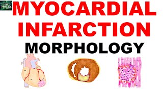 ISCHEMIC HEART DISEASE | part 3 |, Myocardial Infarction: Gross & Microscopic Changes Explained!