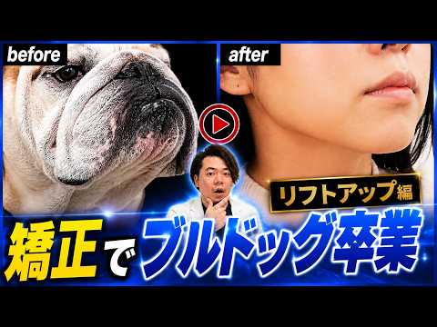 【リフトアップ編】矯正でブルドッグ卒業