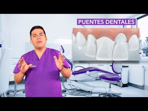 🚨¿Qué es un PUENTE DENTAL? 🧐
