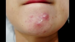 How to get rid of pimples under the skin I 2 Natural Home Remedies that works all the time