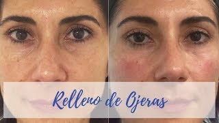 💉RELLENO de OJERAS con ÁCIDO HIALURÓNICO❗️Antes y Después ✅
