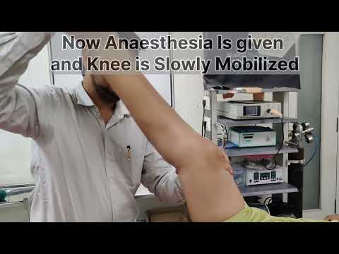 Manipulation Under Anaesthesia for Stiff Knee