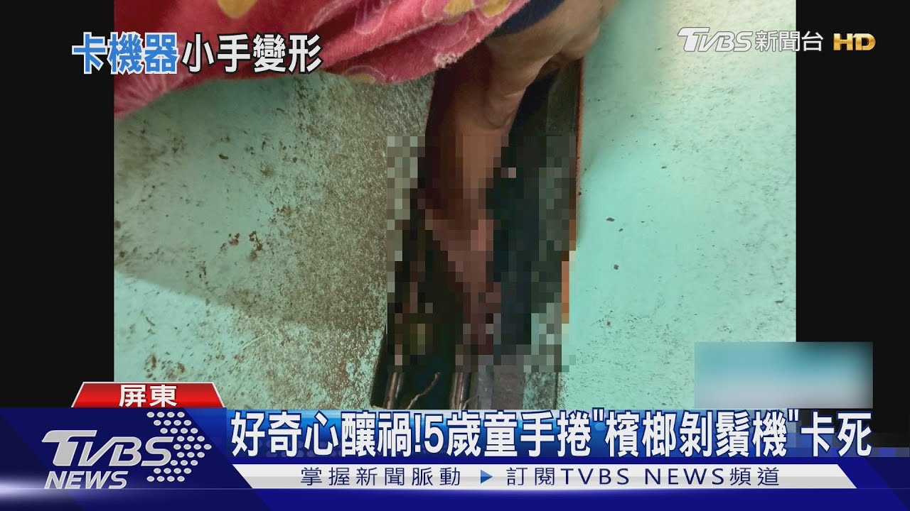 嬉鬧嘸人知! 5歲童手捲「檳榔剝鬚機」 2指變形險截肢