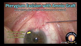 CataractCoach 1238: pterygium excision with amniotic graft (no sutures)