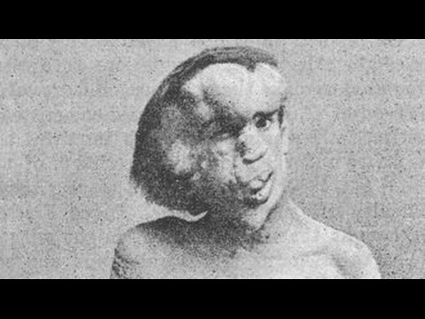 プロテウス症候群