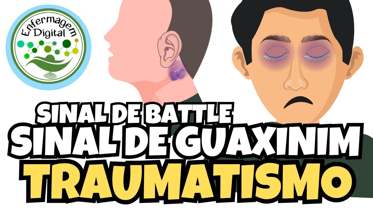 SINAL DE GUAXINIM - FRATURA DE BASE DO CRÂNIO - TCE