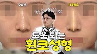 심한 휜코 해결! 자연스럽게 자려한 여자 코성형 11개월 경과 (비중격연골 + 근막)