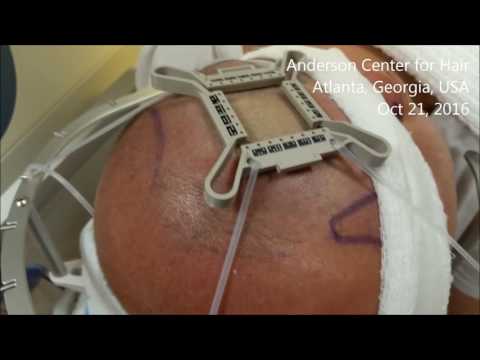 Techniques in Robotic Hair Transplant Surgery - Tensioner placement
