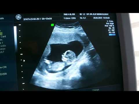12 hafta gebelik izlemi ultrason görüntüsü