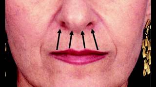 LIP LIFT - QUEILOPLASTIA SUBNASAL. Johnny Pita, Cirujano Plástico