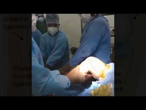 ACL and PCL Complete Tears in a Player. Fixed by Olympic ACL Surgeon Dr Manit Arora