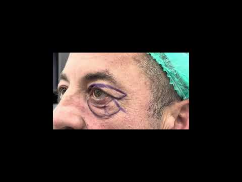 Înainte și după 6 Luni de la operația de Blefaroplastie totală [superioară + inferioară]