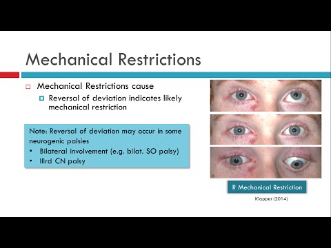 Deviations In Incomitant Strabismus 