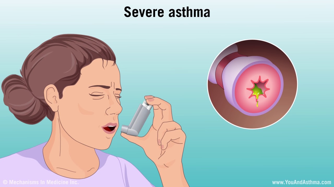 Understanding Asthma: Mild, Moderate, and Severe