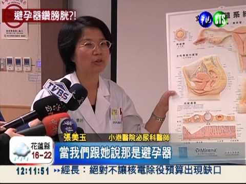 避孕器穿透子宮 鑽進膀胱"結石"