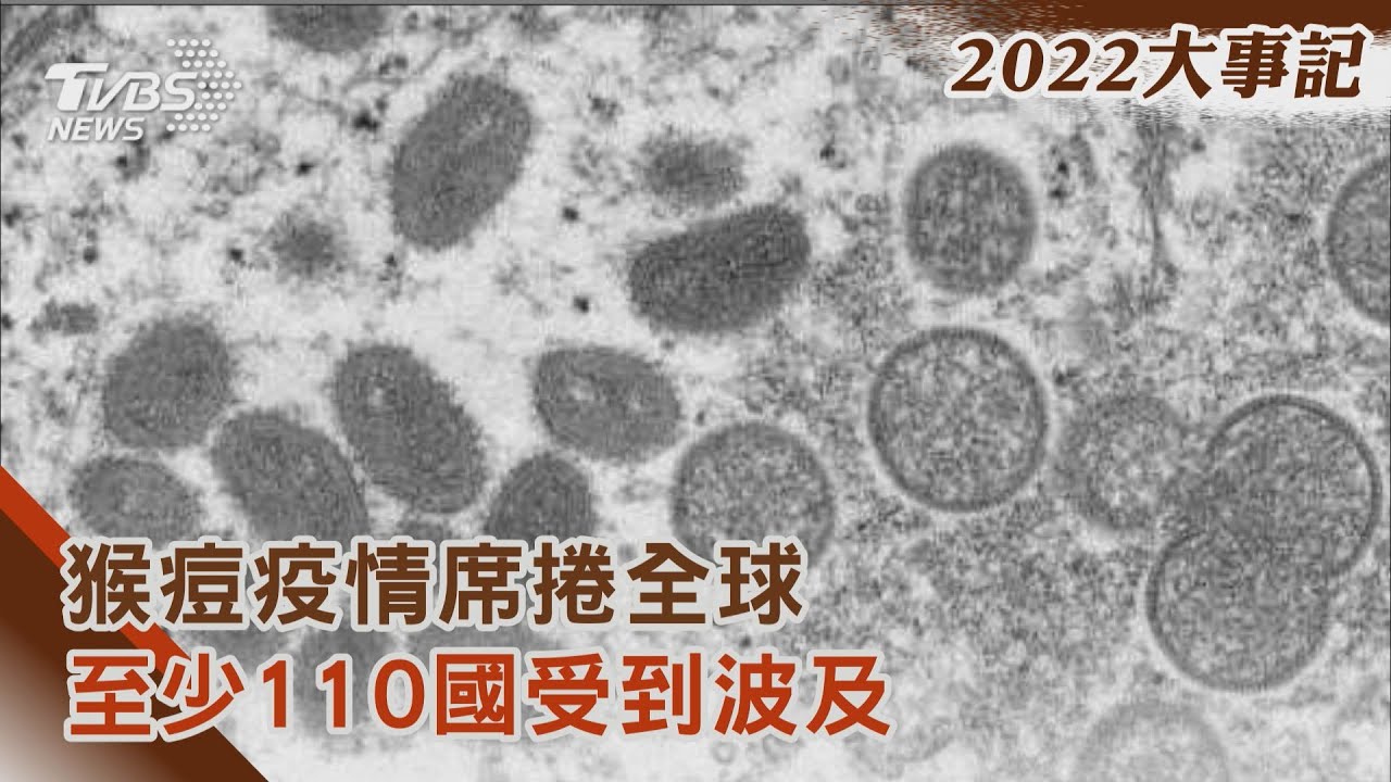 當心!猴痘疫情席捲全球 至少110國受到波及