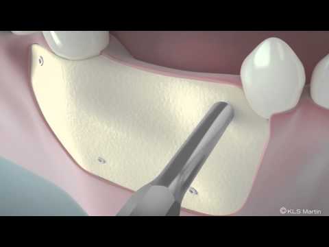 SonicWeld Rx® Dental – Shell technique for horizontal defect augmentation