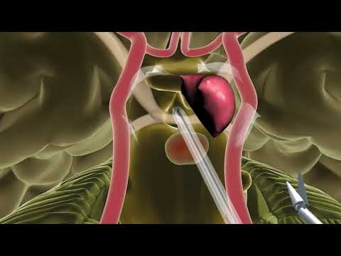 Endoscopic Endonasal Skull Base Surgery - Minimally Invasive Brain Surgery