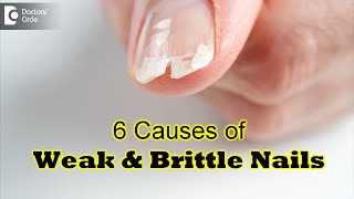 10 Causes of Weak & Brittle Nails | Tips to improve the strength-Dr. Rajdeep Mysore| Doctors