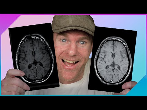 My MRI Shows Myelin REPAIR! | Multiple Sclerosis Recovery