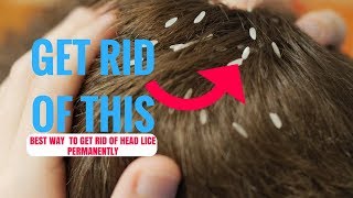 Best Way  to Get Rid of Head Lice Permanently And At Home For Children and Adults