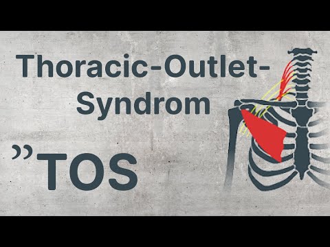 physioHELD: Thoracic-Outlet-Syndrome (TOS) | Adson | Eden | Wright - Test