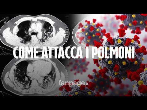Così il Coronavirus colpisce i polmoni dei malati