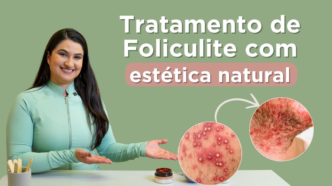 Tratamento de Foliculite 100% natural: 2024