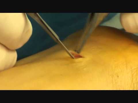 comment traiter syndrome canal carpien