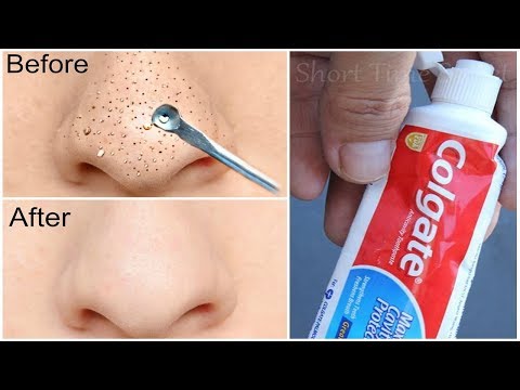 download lagu mp3 mp4 Remove Blackheads With Toothpaste And Salt In Urdu, download lagu Remove Blackheads With Toothpaste And Salt In Urdu gratis, unduh video klip Remove Blackheads With Toothpaste And Salt In Urdu