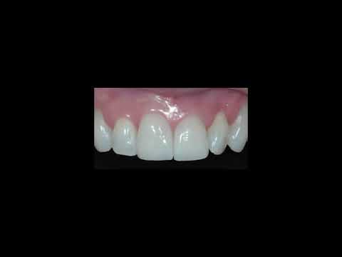Achieving a Natural Look: Complete Guide to Affordable Composite Dental Veneers in Mexico