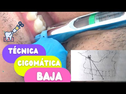 Técnica de Anestesia Cigomática Baja
