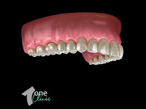 Hollywood Smile & E-Max Veneers - Surgical Procedure - One Clinic Patient Review Video