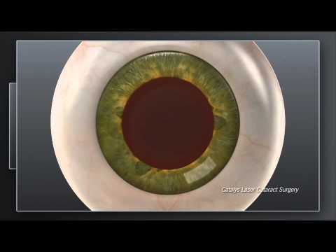 Catalys Animation Narrated - All Incisions