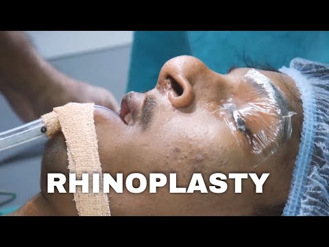 Rhinoplasty- Before And After Nose Correction Surgery
