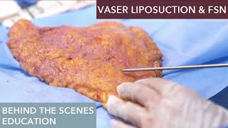How does Vaser Liposuction work?