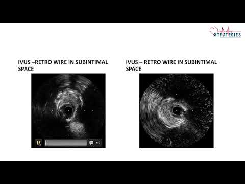 Decoding CTO PCI Strategies (1) | A Case Of  LAD CTO | Dr. Sharath Reddy