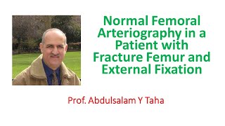 Normal Femoral Arteriography in a Patient with Fracture Femur and External Fixation