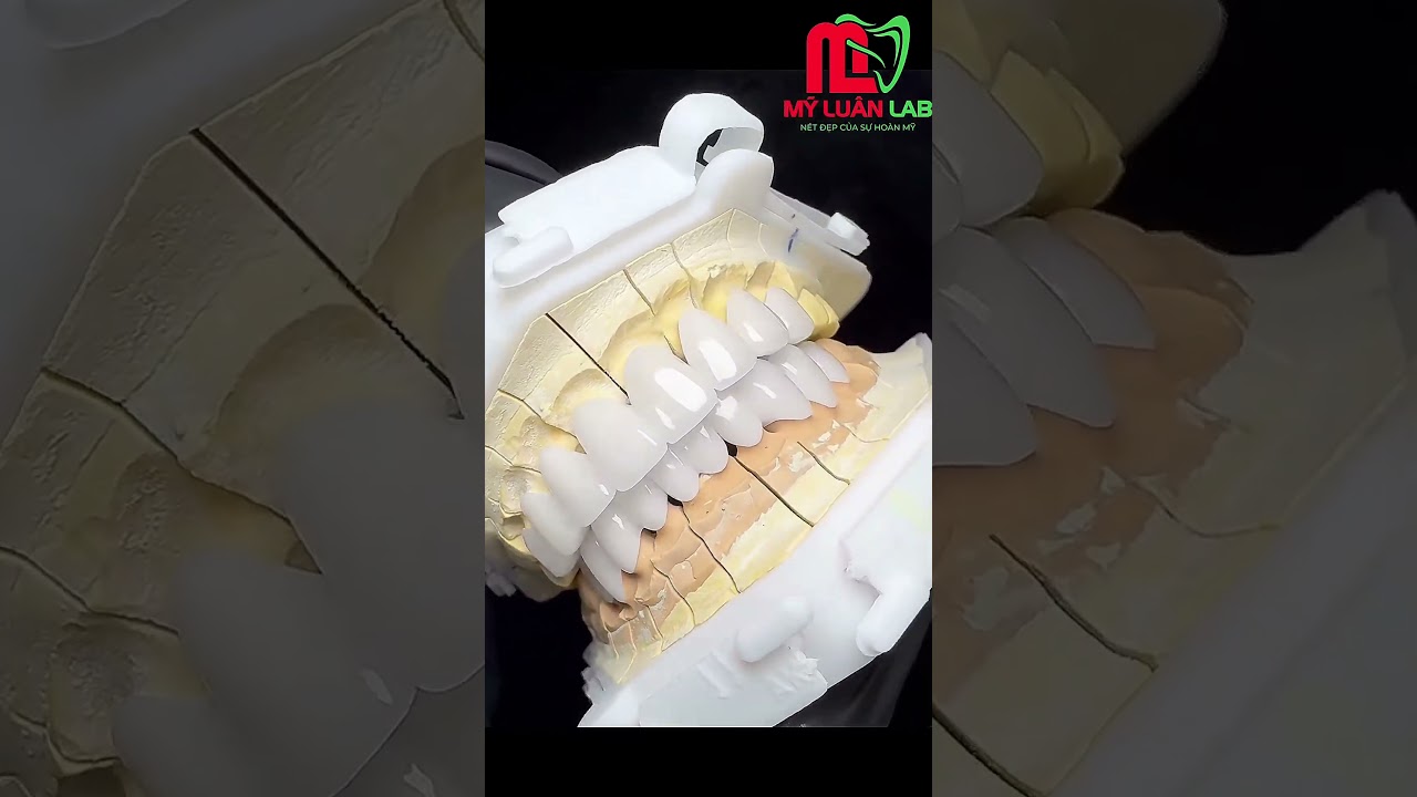 Răng Sứ Siêu Trắng, Siêu Trong| Nụ Cười Tự Nhiên, Thẩm Mỹ Cao Cấp