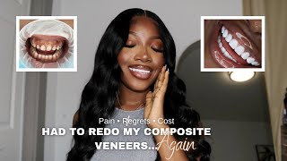 I had to redo my composite veneers again...| before and after photos included