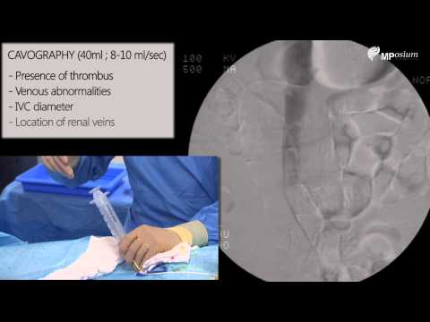 Inferior vena cava filter placement (femoral approach)