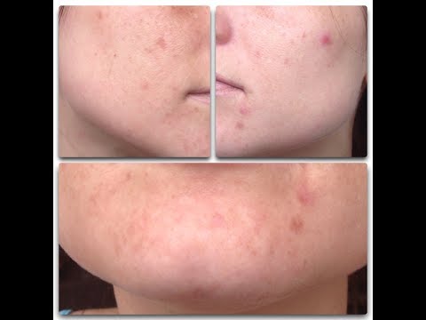 По казахстан удаление пигментных пятен Кукла веснушка как сделать