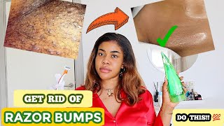 HOW TO STOP AND GET RID OF INGROWN HAIR/RAZOR BUMPS. Must watch