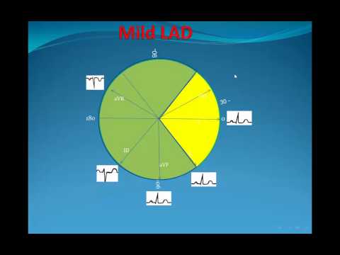 Principles of ECG "electrocardiography" Part 5