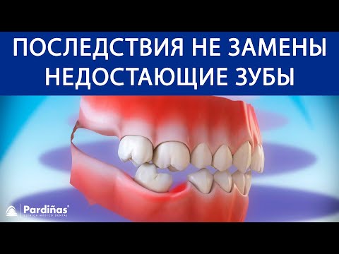 Последствия не замены недостающие зубы ©