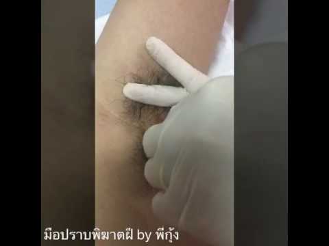 การออกกำลังกายสำหรับการขยายเต้านม คลินิกเสริมเต้านม